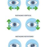 tratamientos-en-pacientes-con-nistagmo